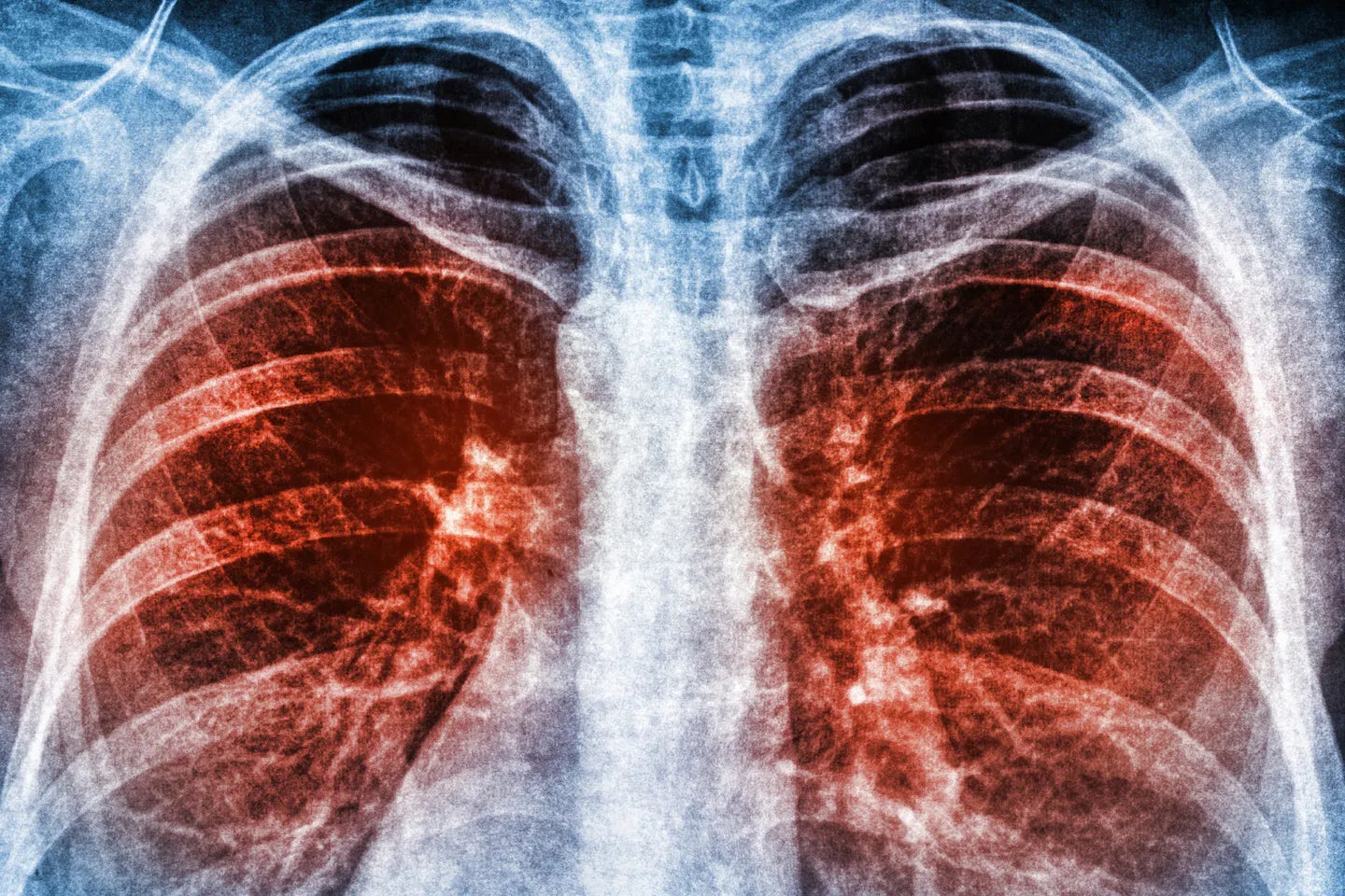 Radiografía de pulmones con COVID
